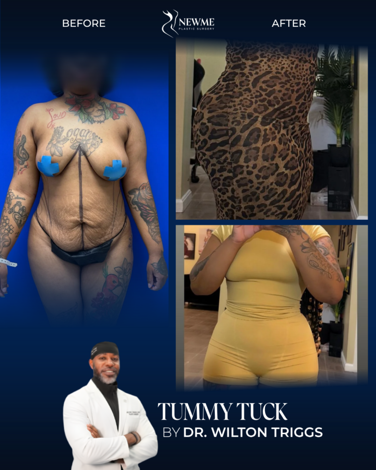 Tummy Tuck result by Dr. Wilton Triggs at New Me Plastic Surgery, Miami