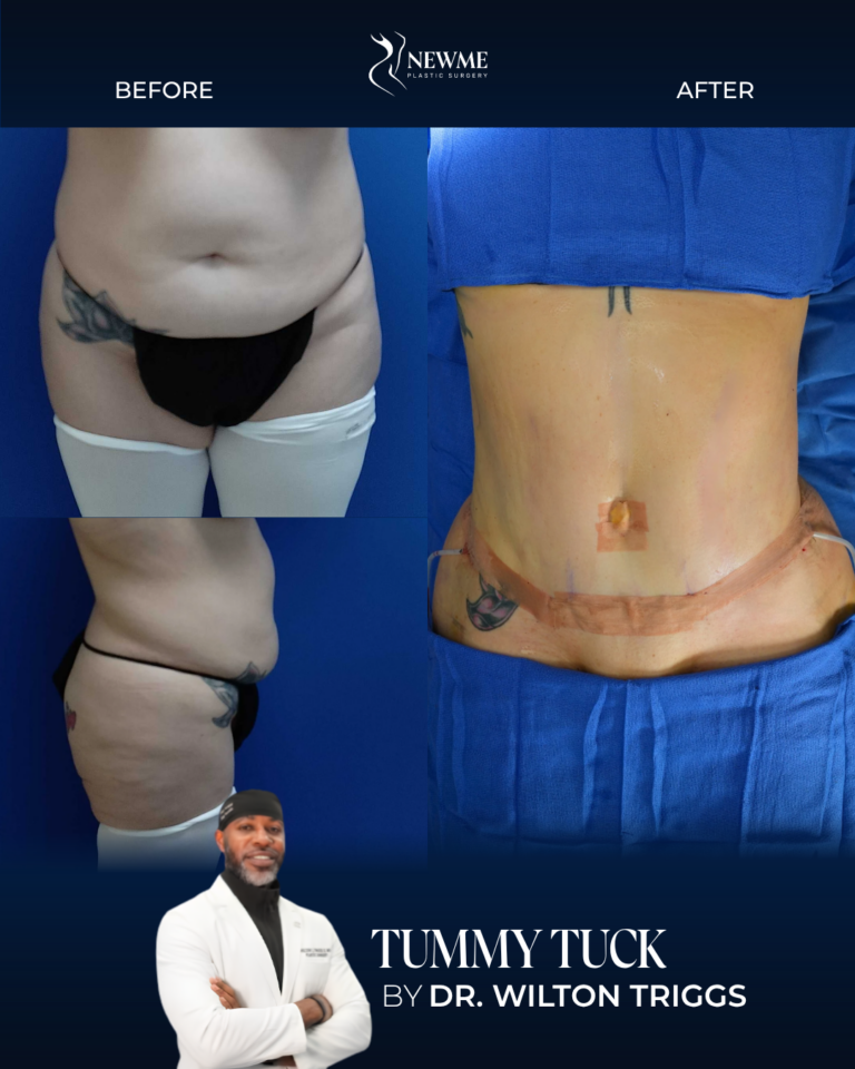 Tummy Tuck result by Dr. Wilton Triggs at New Me Plastic Surgery, Miami