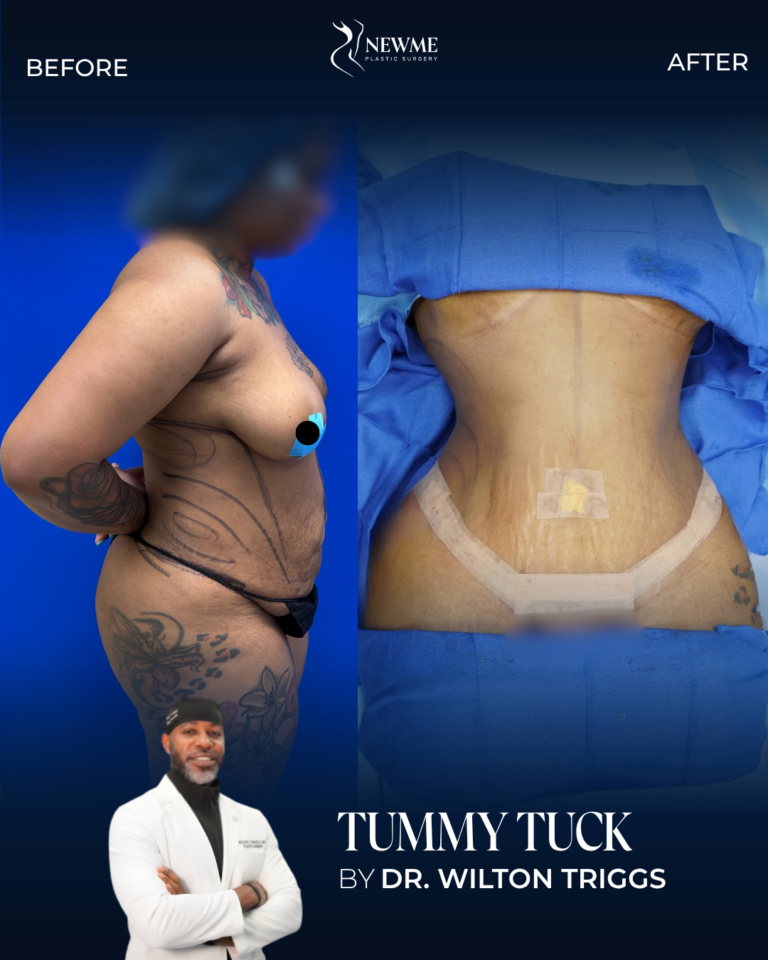 Tummy Tuck result by Dr. Wilton Triggs at New Me Plastic Surgery, Miami