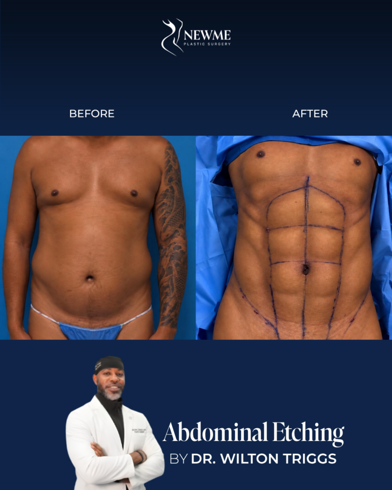 Abdominal Etching result by Dr. Wilton Triggs at New Me Plastic Surgery, Miami