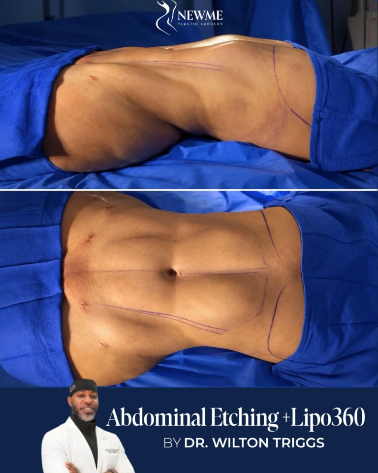 Abdominal Etching result by Dr. Wilton Triggs at New Me Plastic Surgery, Miami