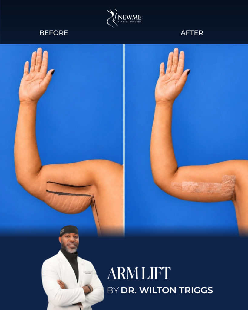 Arm Lift result by Dr. Wilton Triggs at New Me Plastic Surgery, Miami