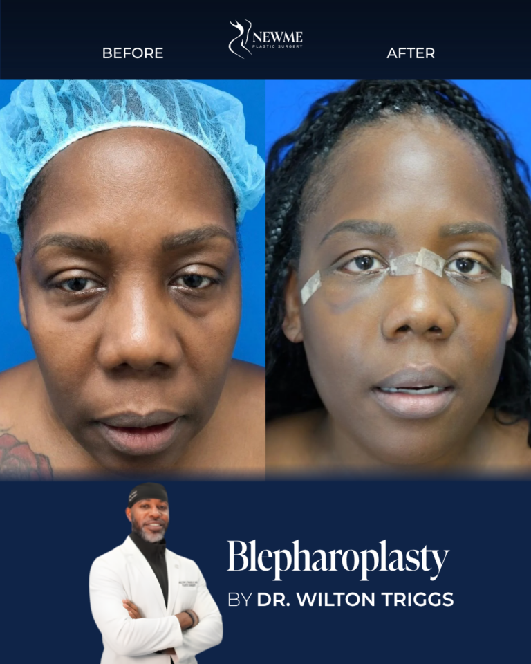 Blepharoplasty result by Dr. Wilton Triggs at New Me Plastic Surgery, Miami