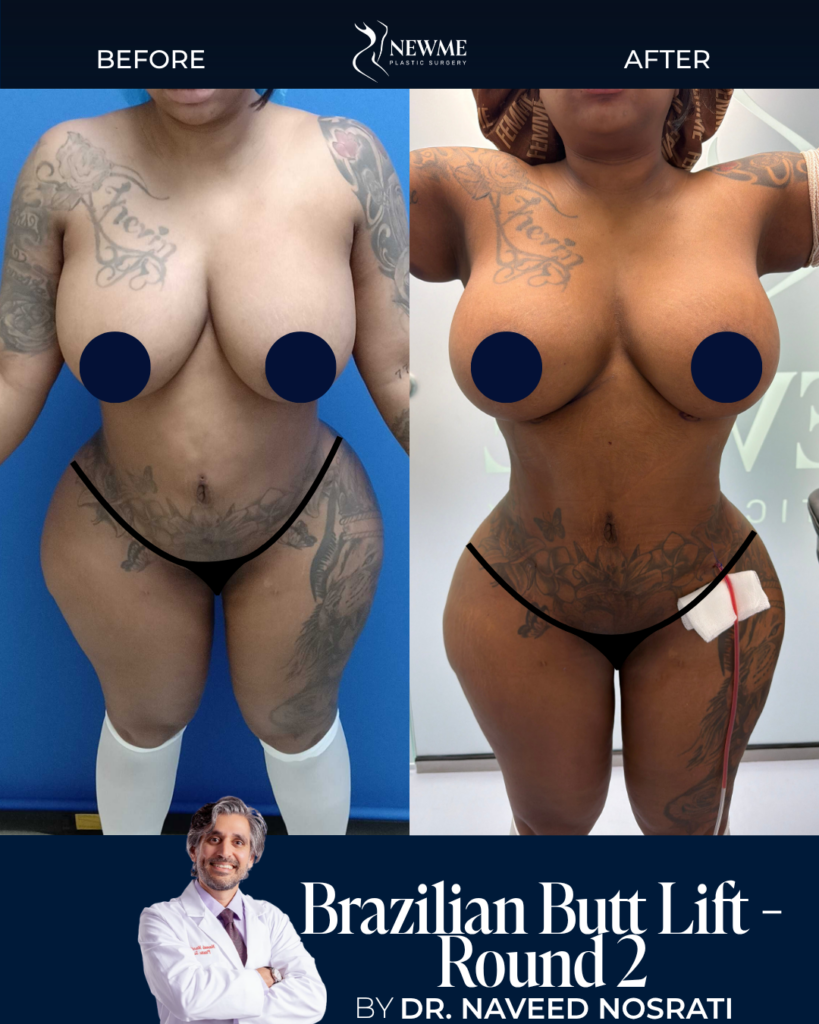 Brazilian Butt Lift result by Dr. Naveed Nosrati at New Me Plastic Surgery, Miami