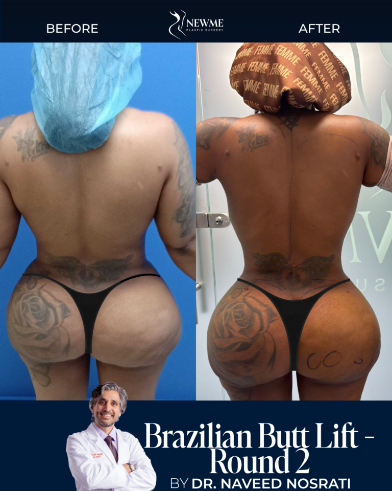 Brazilian Butt Lift result by Dr. Naveed Nosrati at New Me Plastic Surgery, Miami
