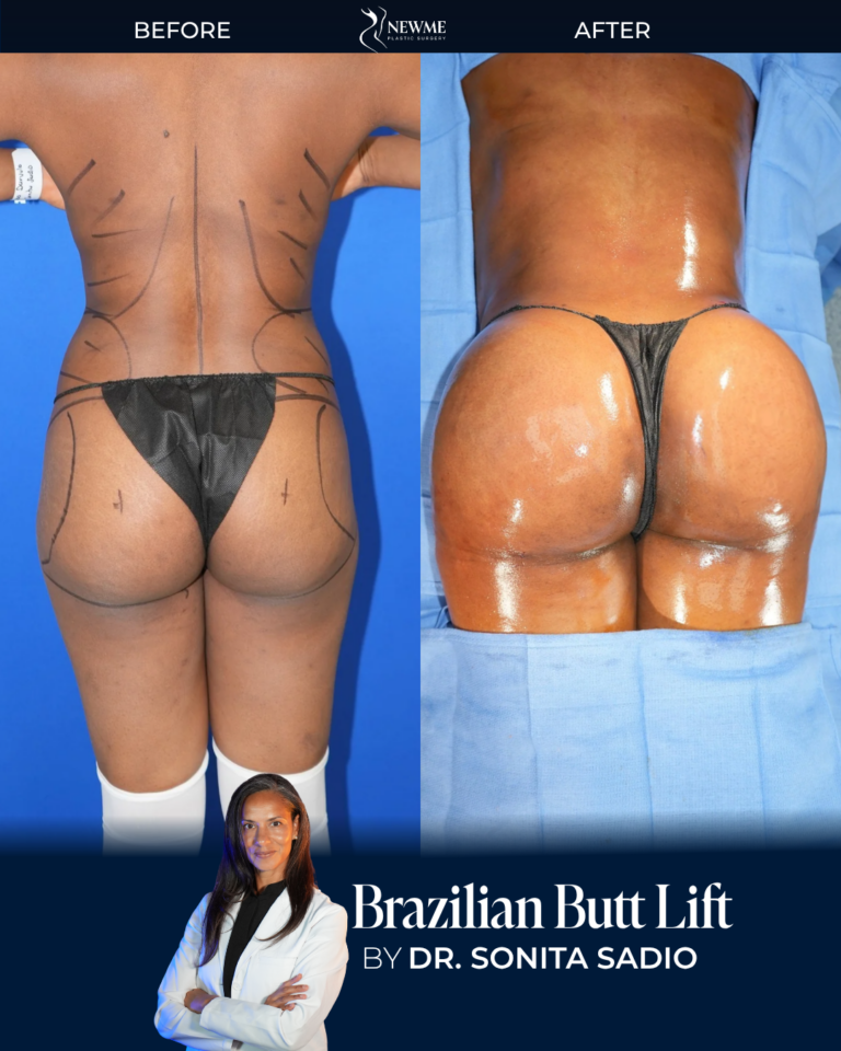 Brazilian Butt Lift result by Dr. Sonita Sadio at New Me Plastic Surgery, Miami