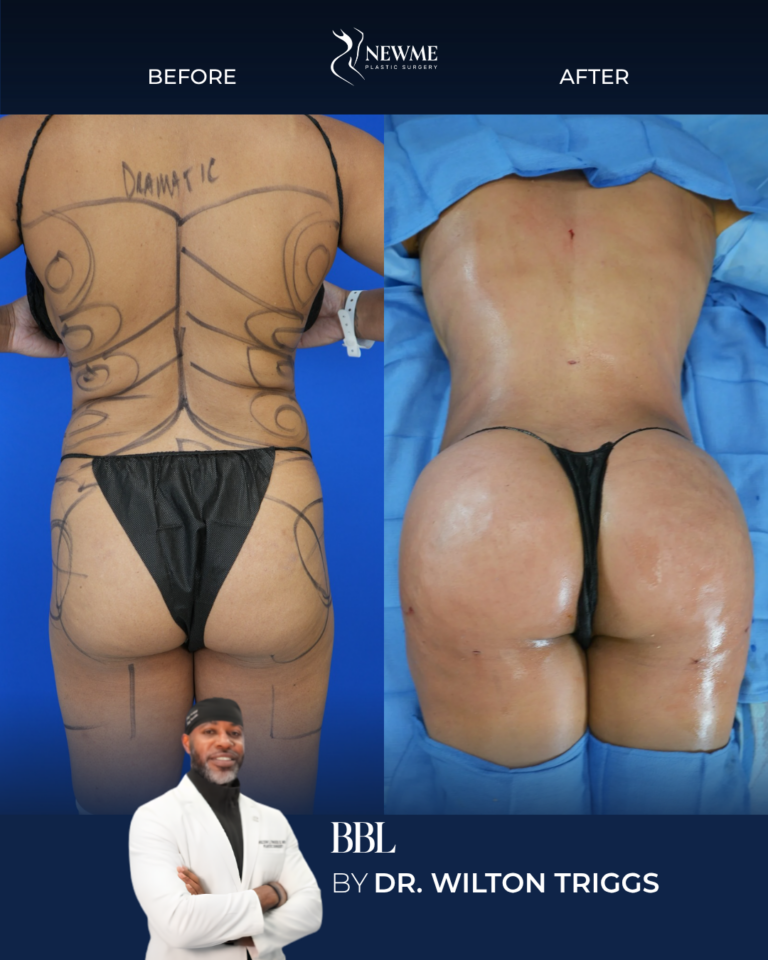 Brazilian Butt Lift result by Dr. Wilton Triggs at New Me Plastic Surgery, Miami