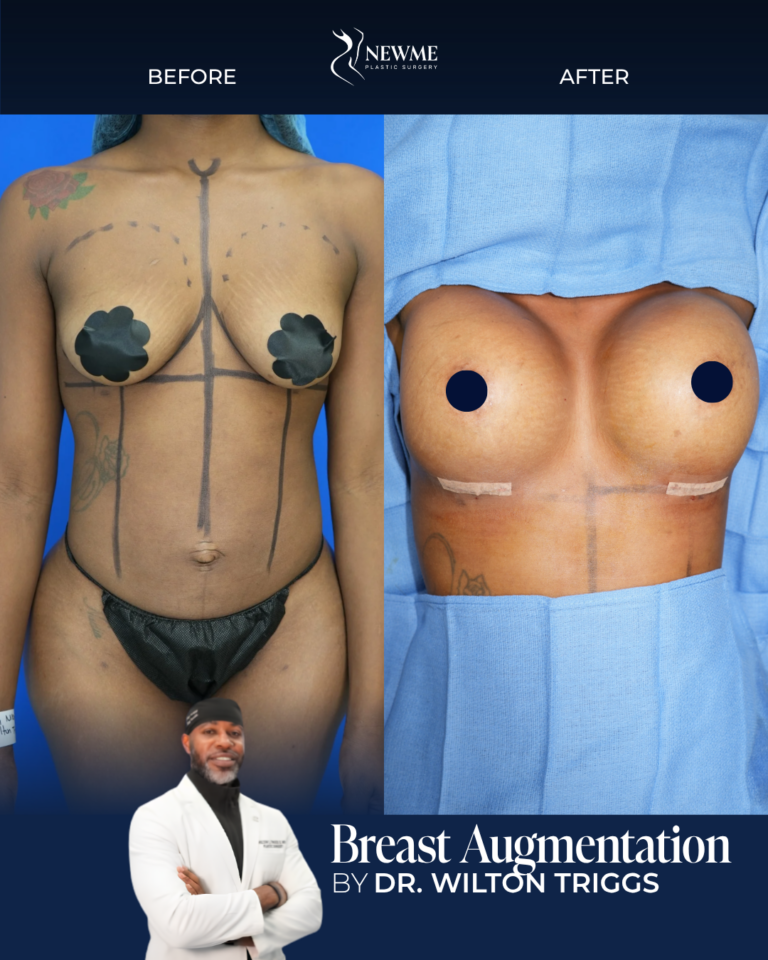 Breast Augmentation result by Dr. Wilton Triggs at New Me Plastic Surgery, Miami