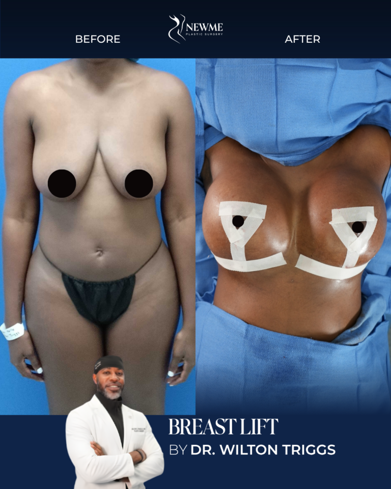 Breast Lift result by Dr. Wilton Triggs at New Me Plastic Surgery, Miami