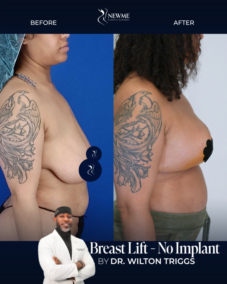 Breast Lift result by Dr. Wilton Triggs at New Me Plastic Surgery, Miami