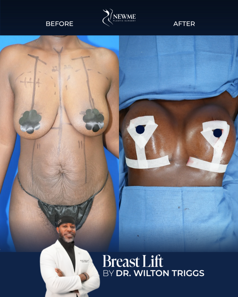 Breast Lift result by Dr. Wilton Triggs at New Me Plastic Surgery, Miami