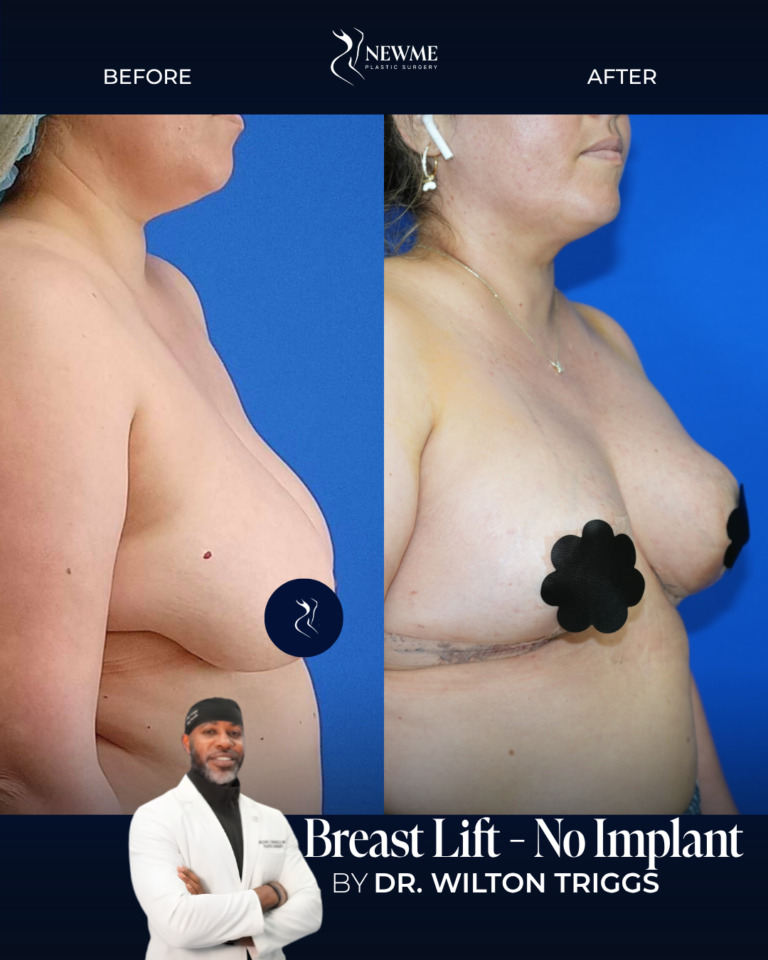 Breast Lift result by Dr. Wilton Triggs at New Me Plastic Surgery, Miami