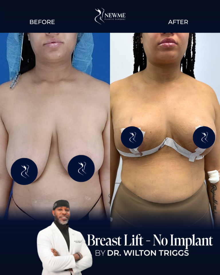 Breast Lift result by Dr. Wilton Triggs at New Me Plastic Surgery, Miami