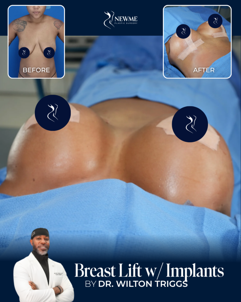 Breast Lift with Implants result by Dr. Wilton Triggs at New Me Plastic Surgery, Miami