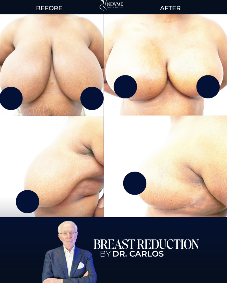 Breast Reduction result by Dr. Carlos at New Me Plastic Surgery, Miami