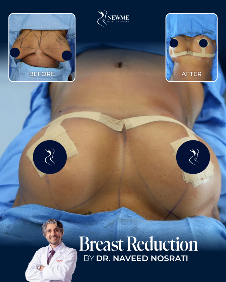 Breast Reduction result by Dr. Naveed Nosrati at New Me Plastic Surgery, Miami