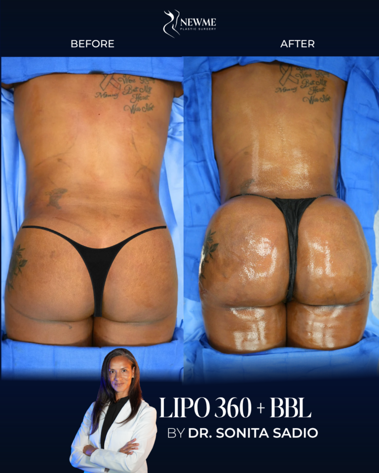 Lipo 360 + BBL result by Dr. Sonita Sadio at New Me Plastic Surgery, Miami