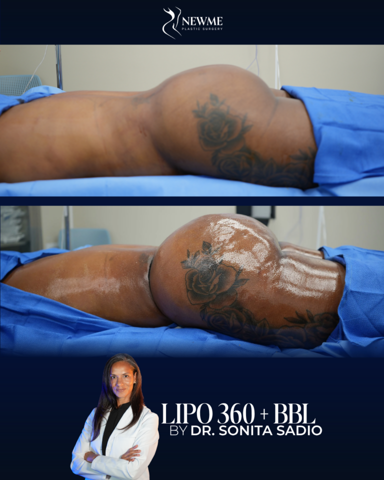 Lipo 360 + BBL result by Dr. Sonita Sadio at New Me Plastic Surgery, Miami
