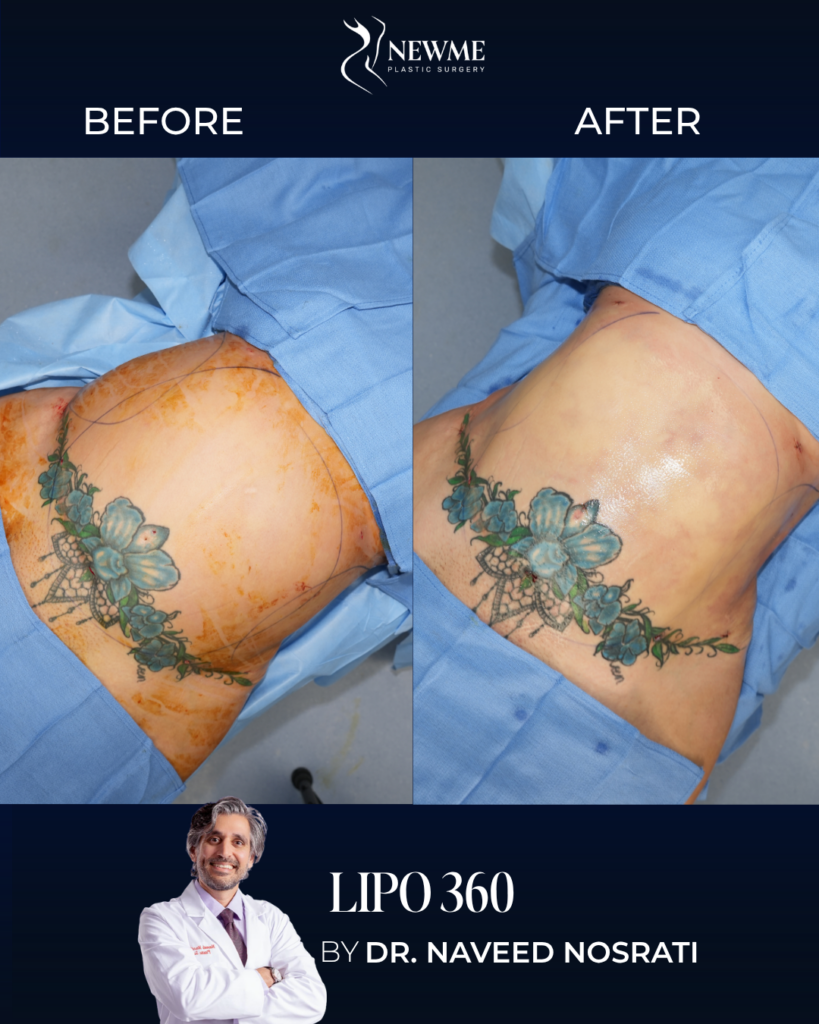 Lipo 360 result by Dr. Naveed Nosrati at New Me Plastic Surgery, Miami