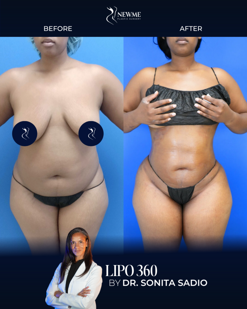 Lipo 360 result by Dr. Sonita Sadio at New Me Plastic Surgery, Miami