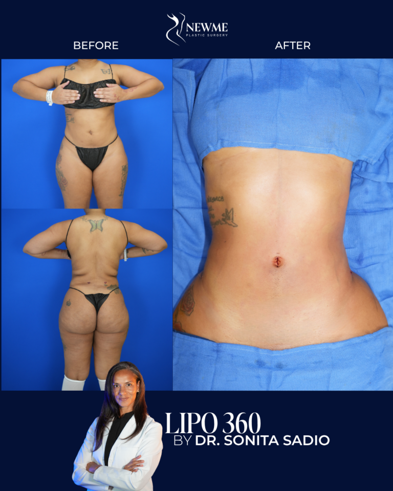 Lipo 360 result by Dr. Sonita Sadio at New Me Plastic Surgery, Miami