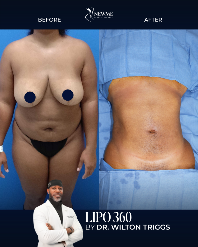 Lipo 360 result by Dr. Wilton Triggs at New Me Plastic Surgery, Miami