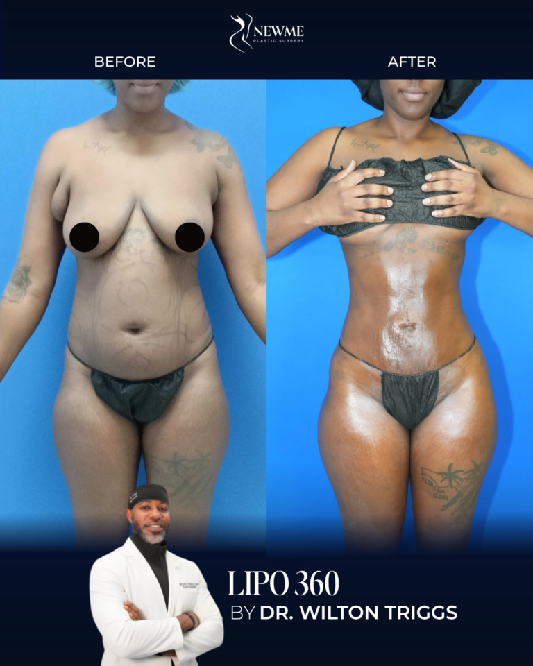 Lipo 360 result by Dr. Wilton Triggs at New Me Plastic Surgery, Miami