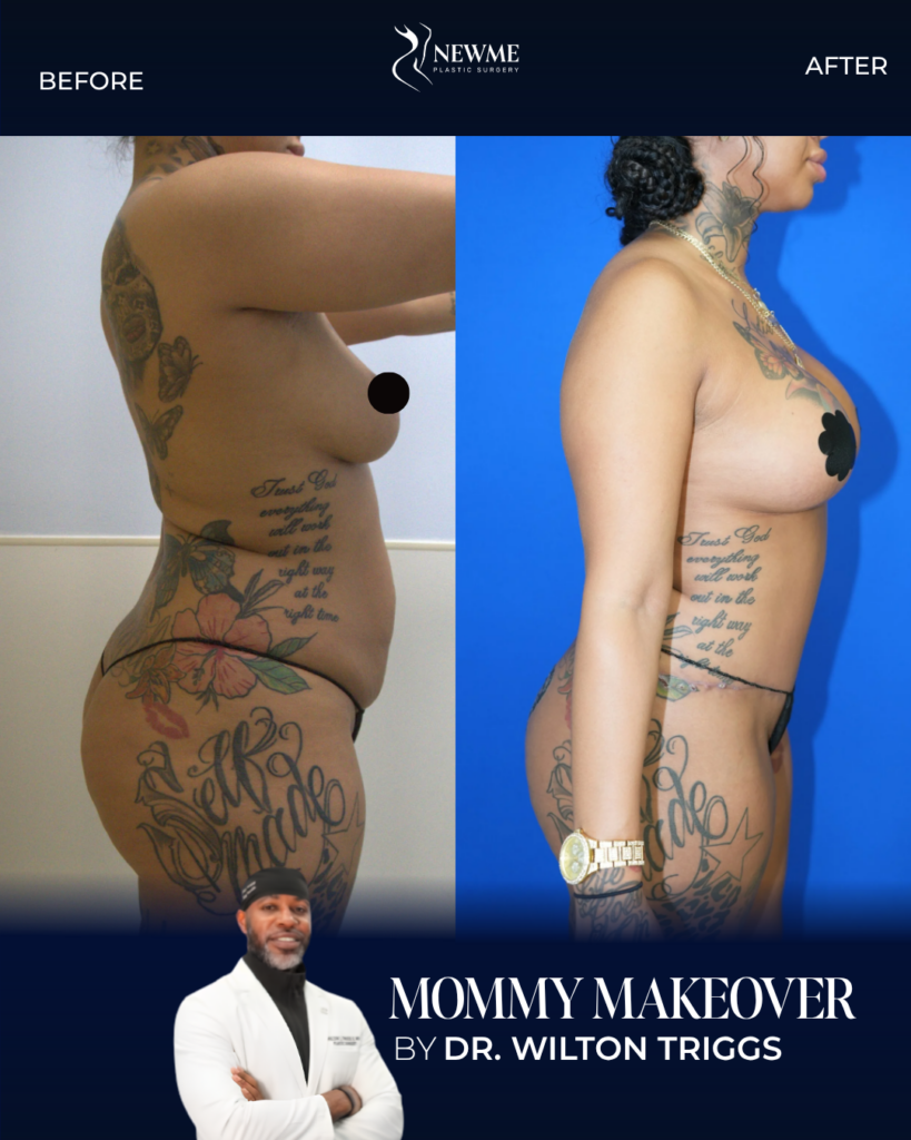 Mommy Makeover result by Dr. Wilton Triggs at New Me Plastic Surgery, Miami