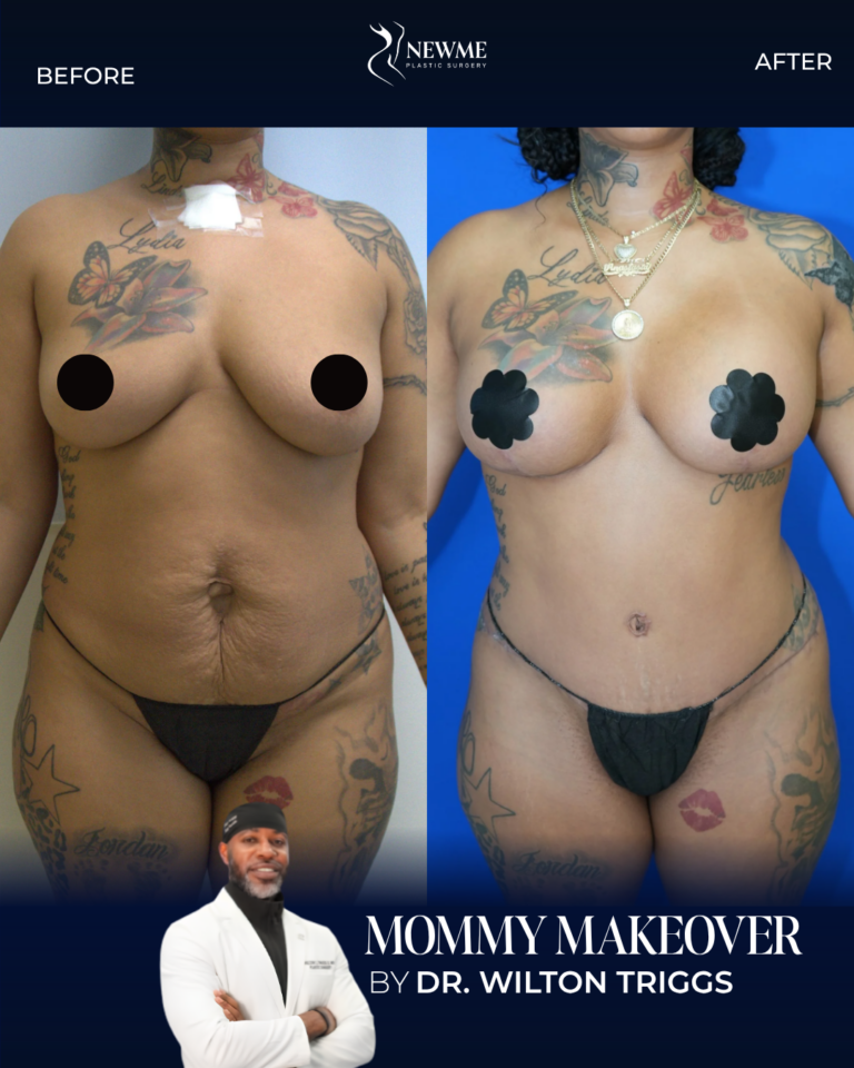 Mommy Makeover result by Dr. Wilton Triggs at New Me Plastic Surgery, Miami