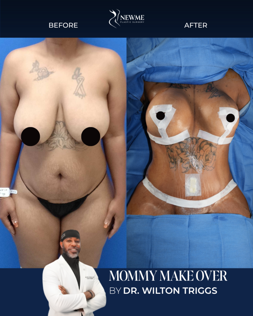 Mommy Makeover result by Dr. Wilton Triggs at New Me Plastic Surgery, Miami