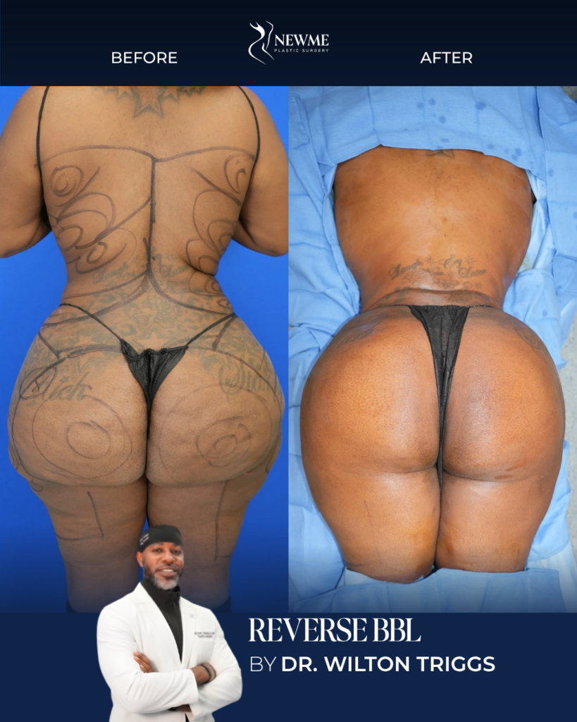 Reverse BBL result by Dr. Wilton Triggs at New Me Plastic Surgery, Miami