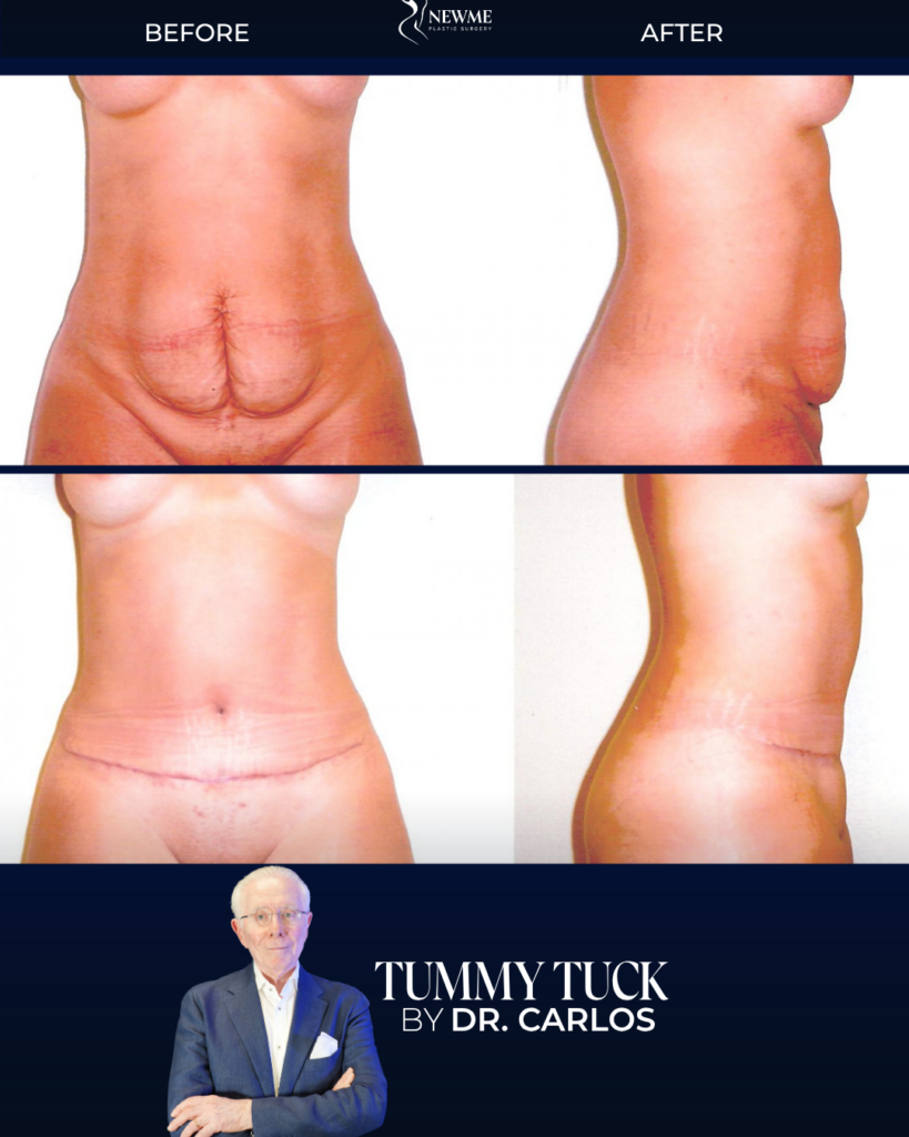 Tummy Tuck result by Dr. Carlos at New Me Plastic Surgery, Miami