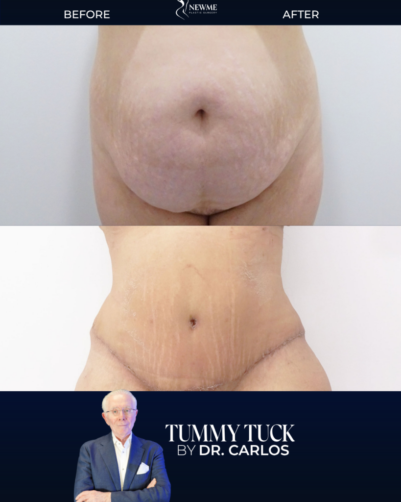 Tummy Tuck result by Dr. Carlos at New Me Plastic Surgery, Miami