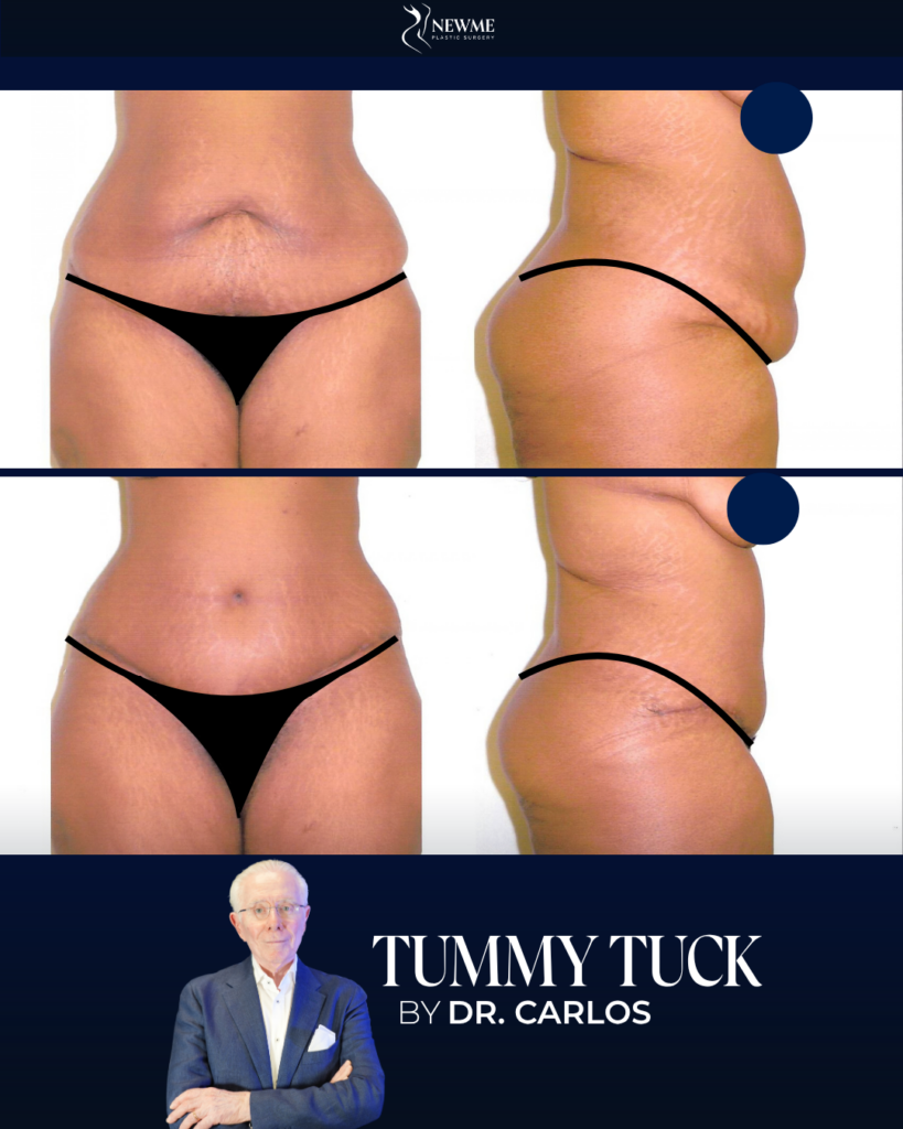 Tummy Tuck result by Dr. Carlos at New Me Plastic Surgery, Miami