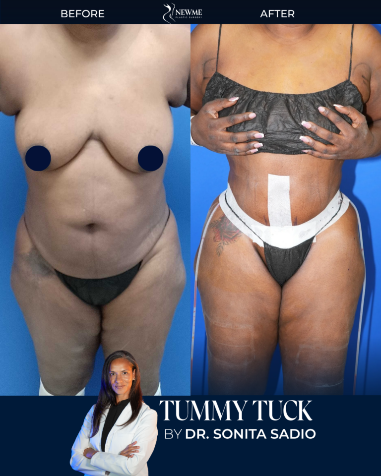 Tummy Tuck result by Dr. Sonita Sadio at New Me Plastic Surgery, Miami