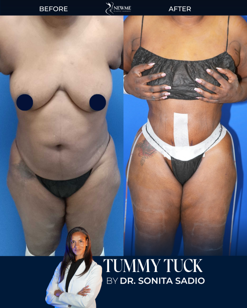 Tummy Tuck result by Dr. Sonita Sadio at New Me Plastic Surgery, Miami
