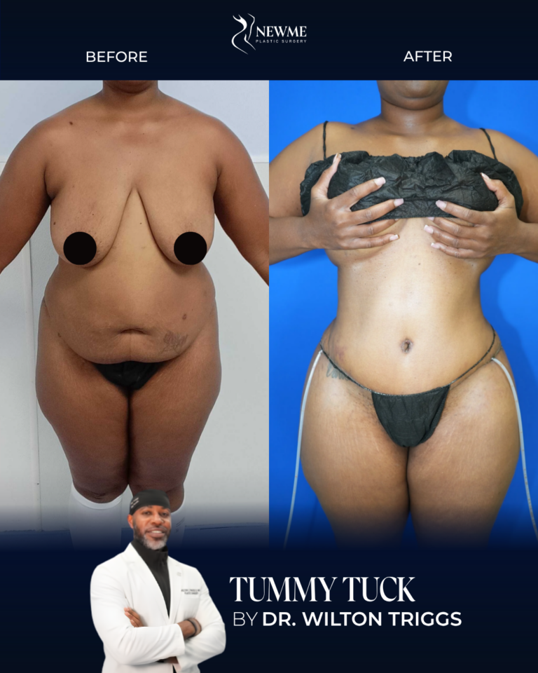 Tummy Tuck result by Dr. Wilton Triggs at New Me Plastic Surgery, Miami