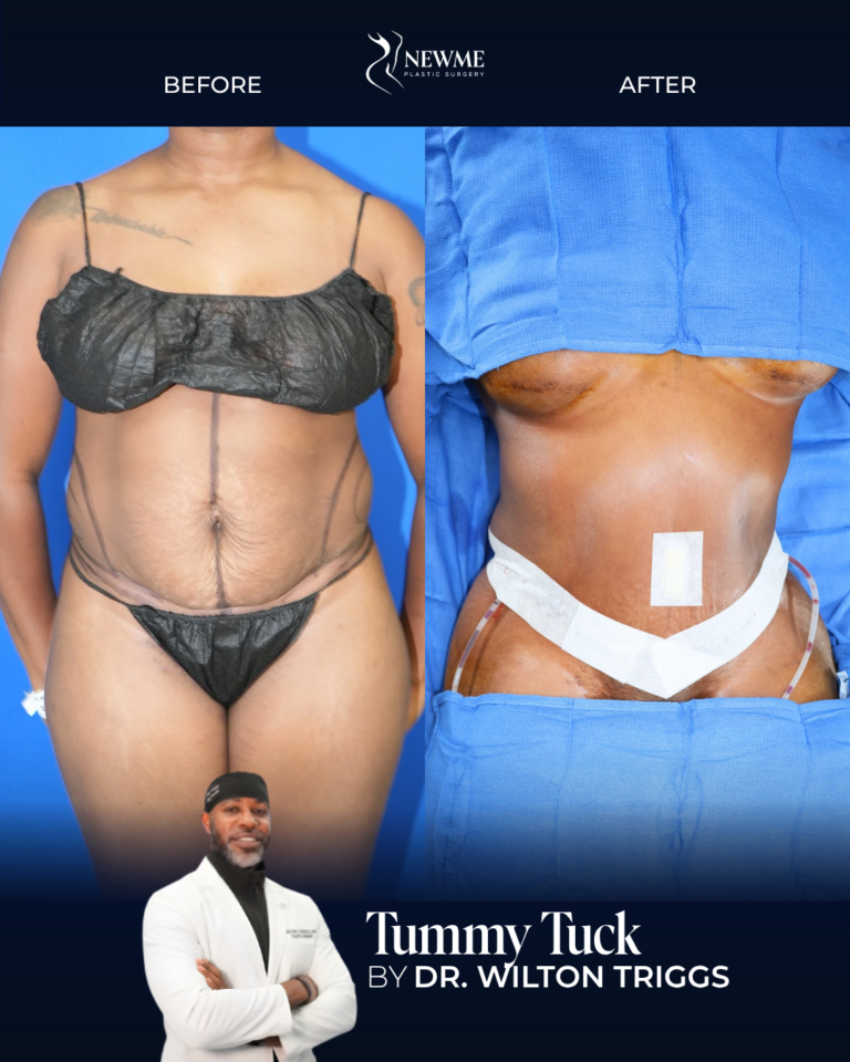 Tummy Tuck result by Dr. Wilton Triggs at New Me Plastic Surgery, Miami