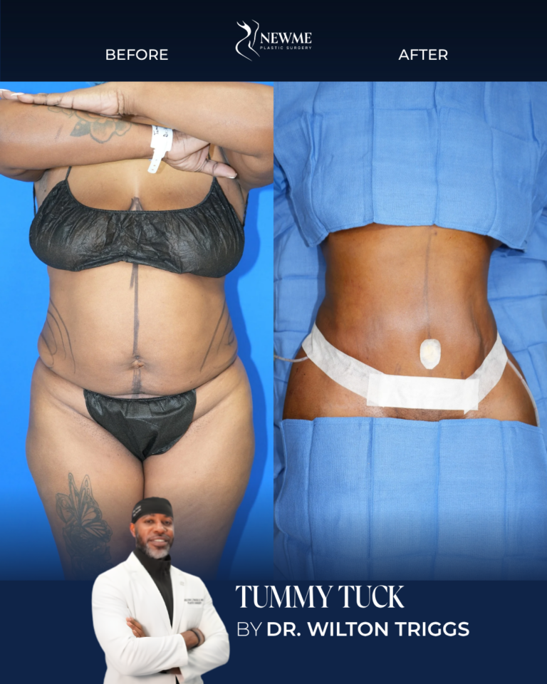 Tummy Tuck result by Dr. Wilton Triggs at New Me Plastic Surgery, Miami