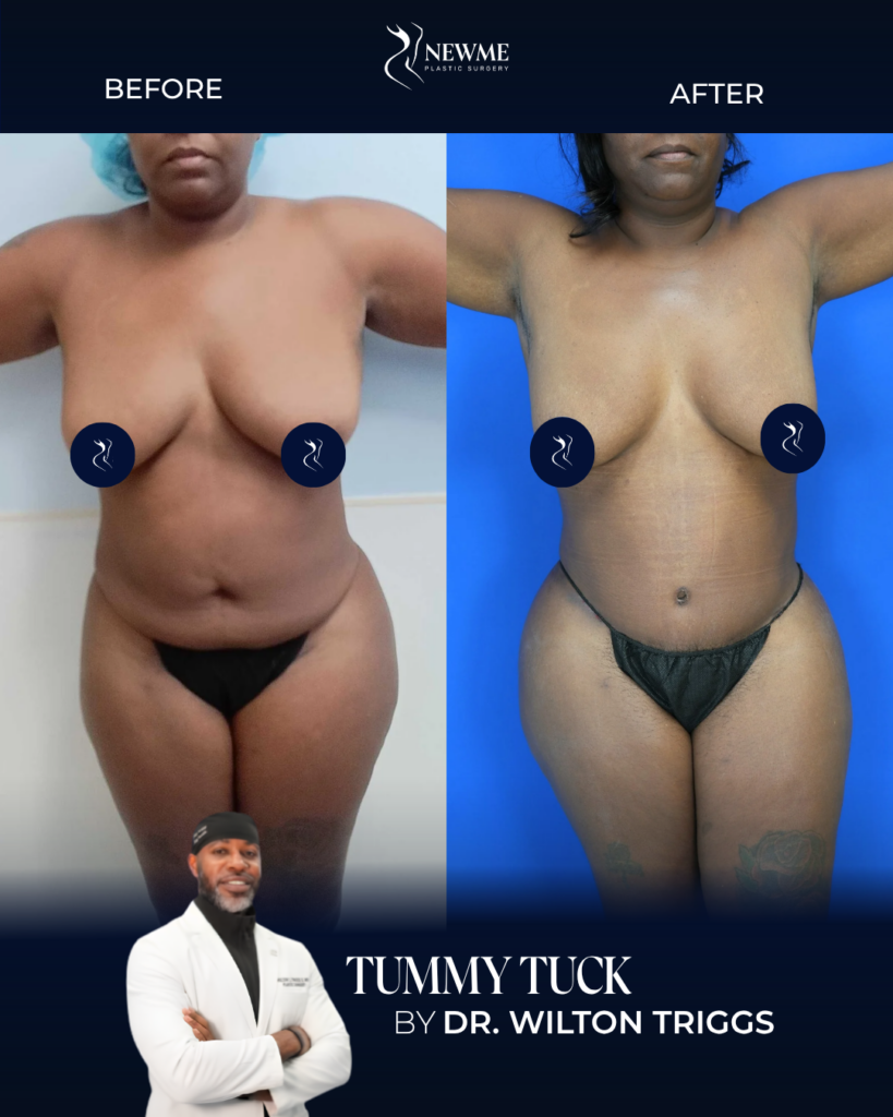 Tummy Tuck result by Dr. Wilton Triggs at New Me Plastic Surgery, Miami