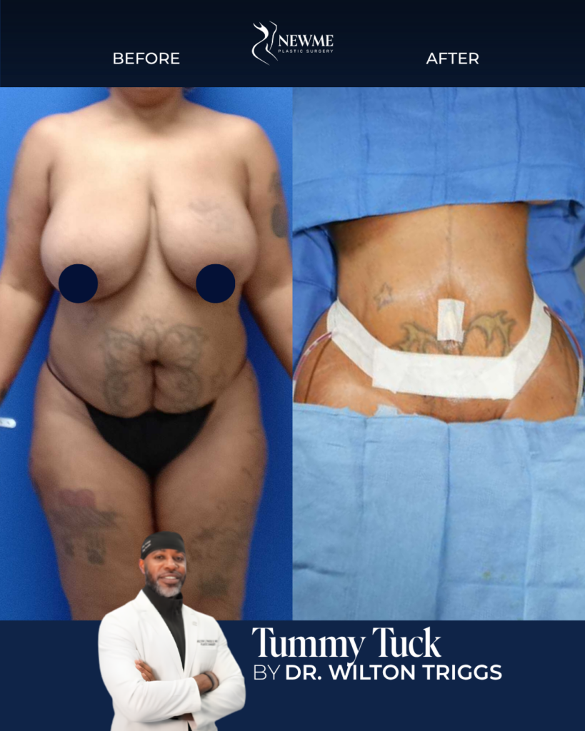 Tummy Tuck result by Dr. Wilton Triggs at New Me Plastic Surgery, Miami