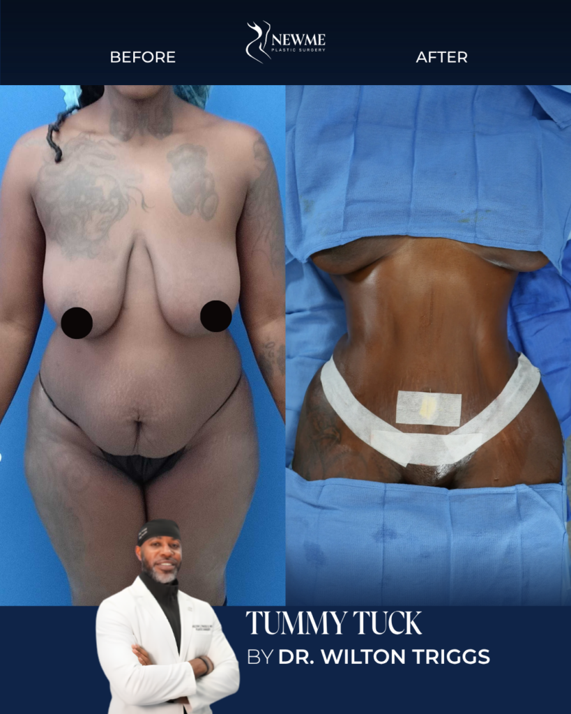 Tummy Tuck result by Dr. Wilton Triggs at New Me Plastic Surgery, Miami
